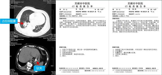 小鈦夾，威力大 ——記一例上消化道大出血患者的救治經(jīng)過(圖2)