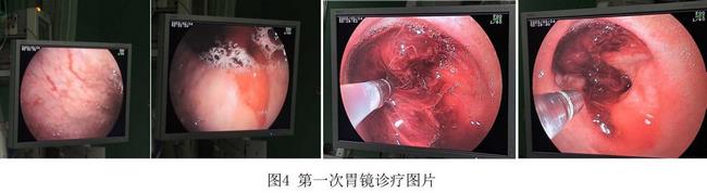 癡呆老人命懸一線，內(nèi)鏡止血彰顯奇功(圖2)