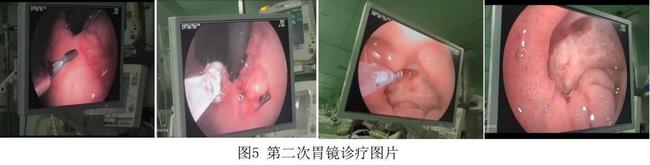癡呆老人命懸一線，內(nèi)鏡止血彰顯奇功(圖3)