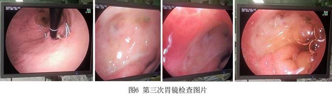 癡呆老人命懸一線，內(nèi)鏡止血彰顯奇功(圖4)