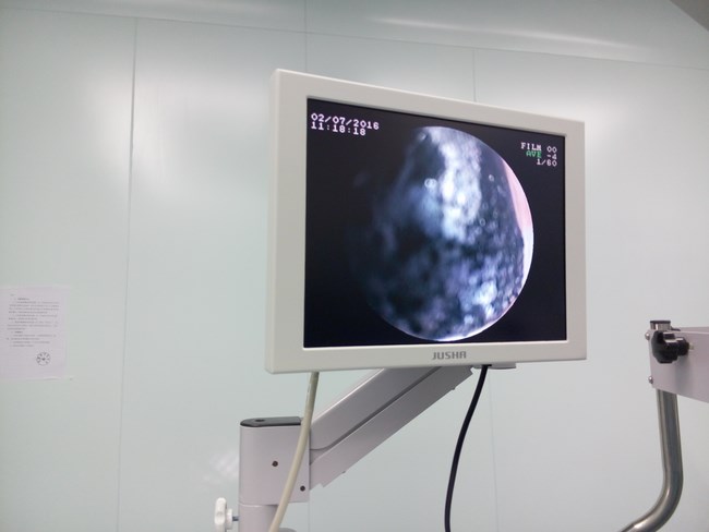 我院開展第一例腹腔鏡下膽總管切開取石術(圖2)